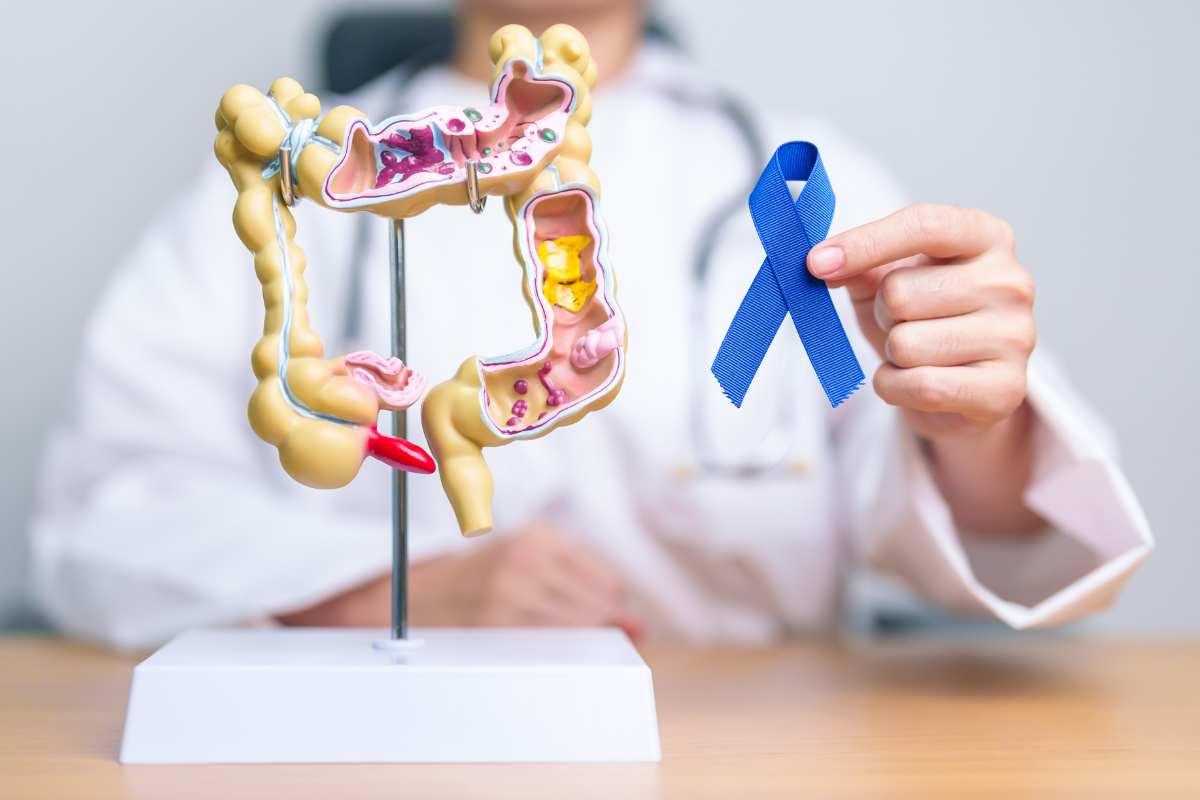 cancro colon boom di casi il motivo